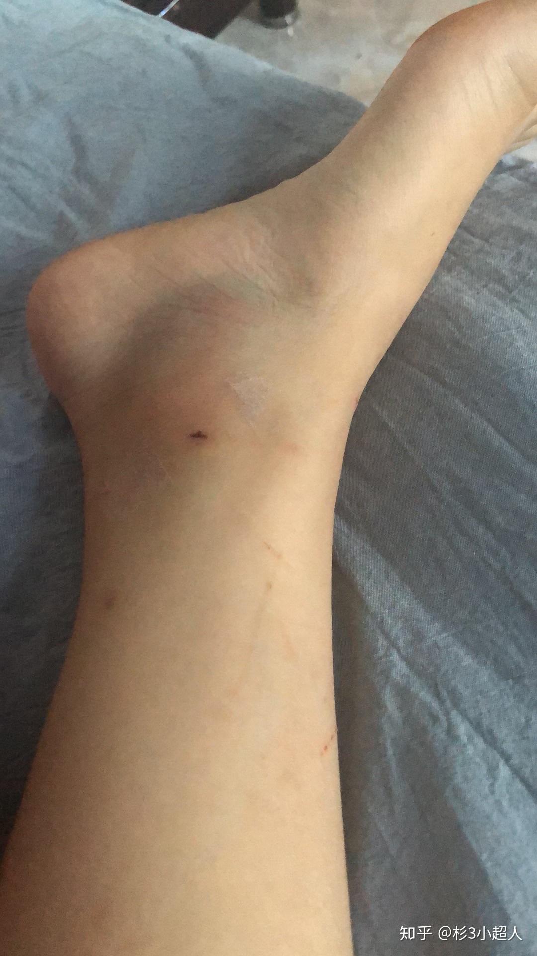崴脚记录 - 知乎