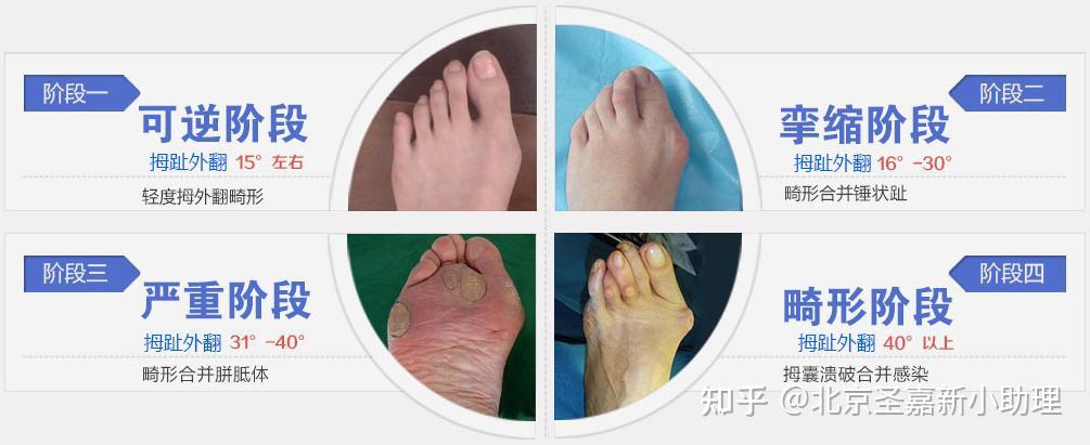 拇外翻人士速进：“大脚骨”突出怎么治疗？ - 知乎