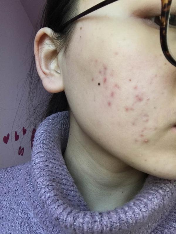 过度刷酸爆痘,真皮层受损.怎么办?