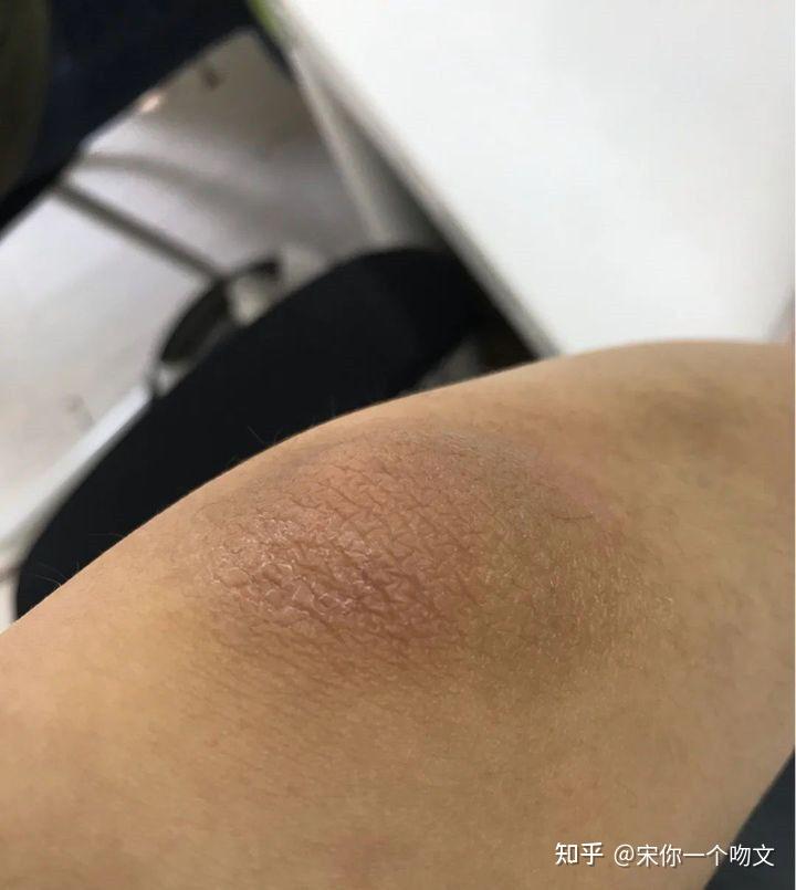 关节黑怎么美白