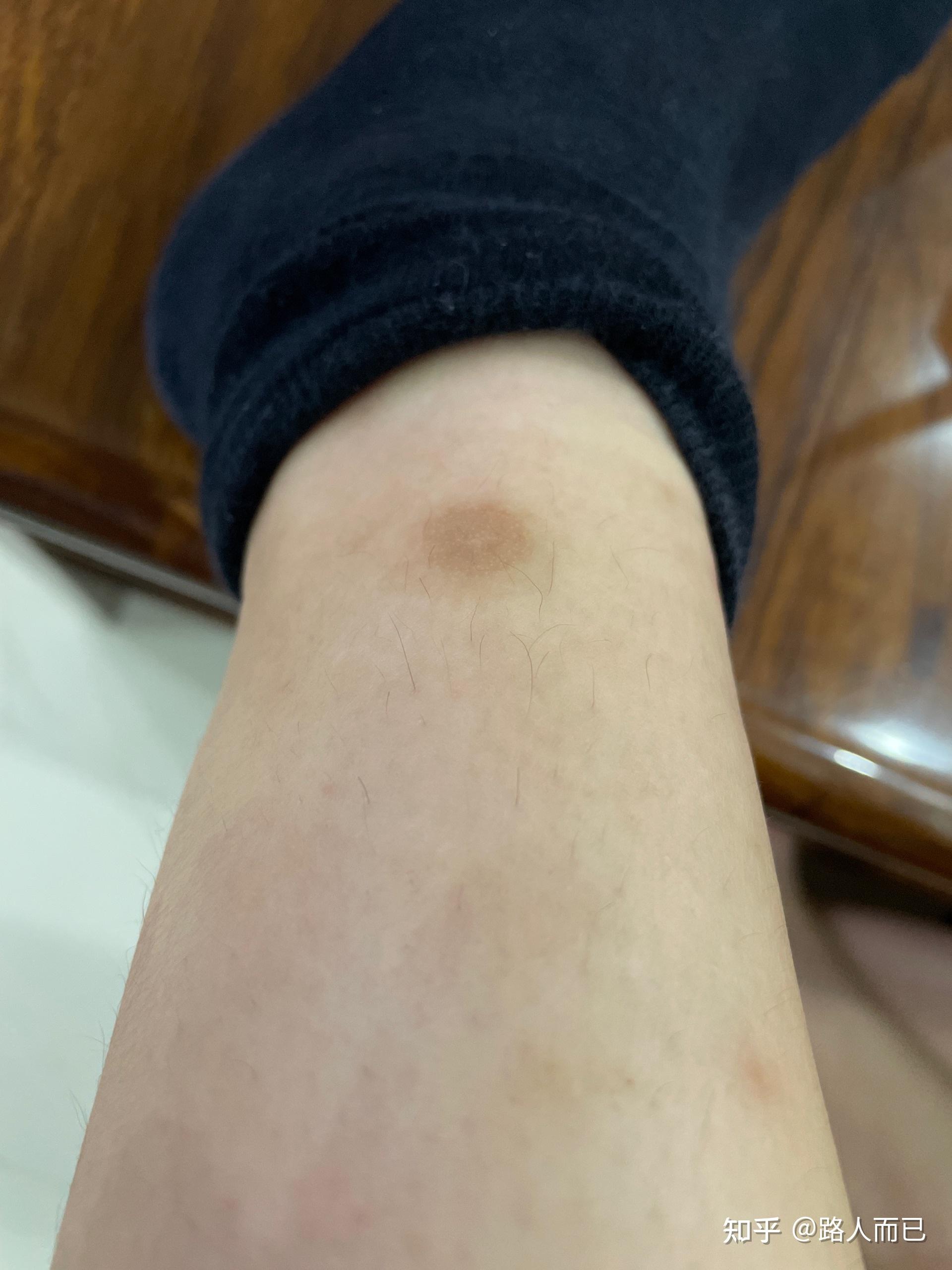 我觉得这是新冠疫苗的不良反应被蚊虫咬后多数起水泡以前不会的