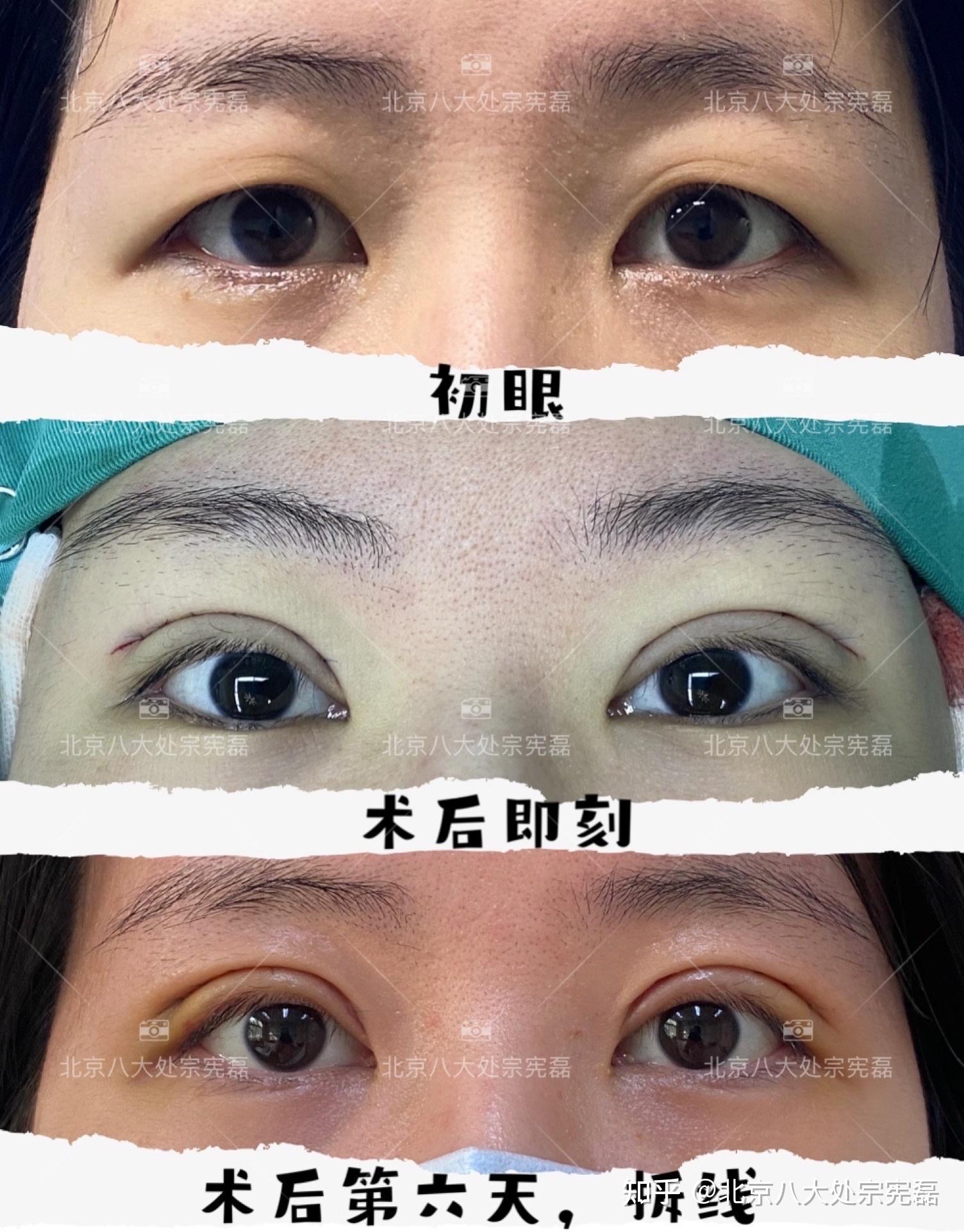 双眼皮修复：双眼皮手术几年后眼皮下垂怎么办？_双眼皮修复_双眼皮修复治疗介绍 - 好大夫在线