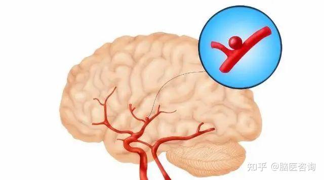 突發腦出血怎麼辦這些知識點要記下關鍵時刻可救命