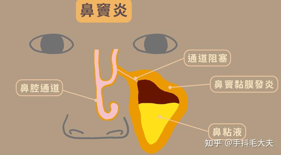 原来鼻炎患者洗鼻子的窍门这么多，看看我怎么洗鼻子 - 知乎
