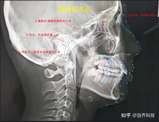 头影测量标志点图解