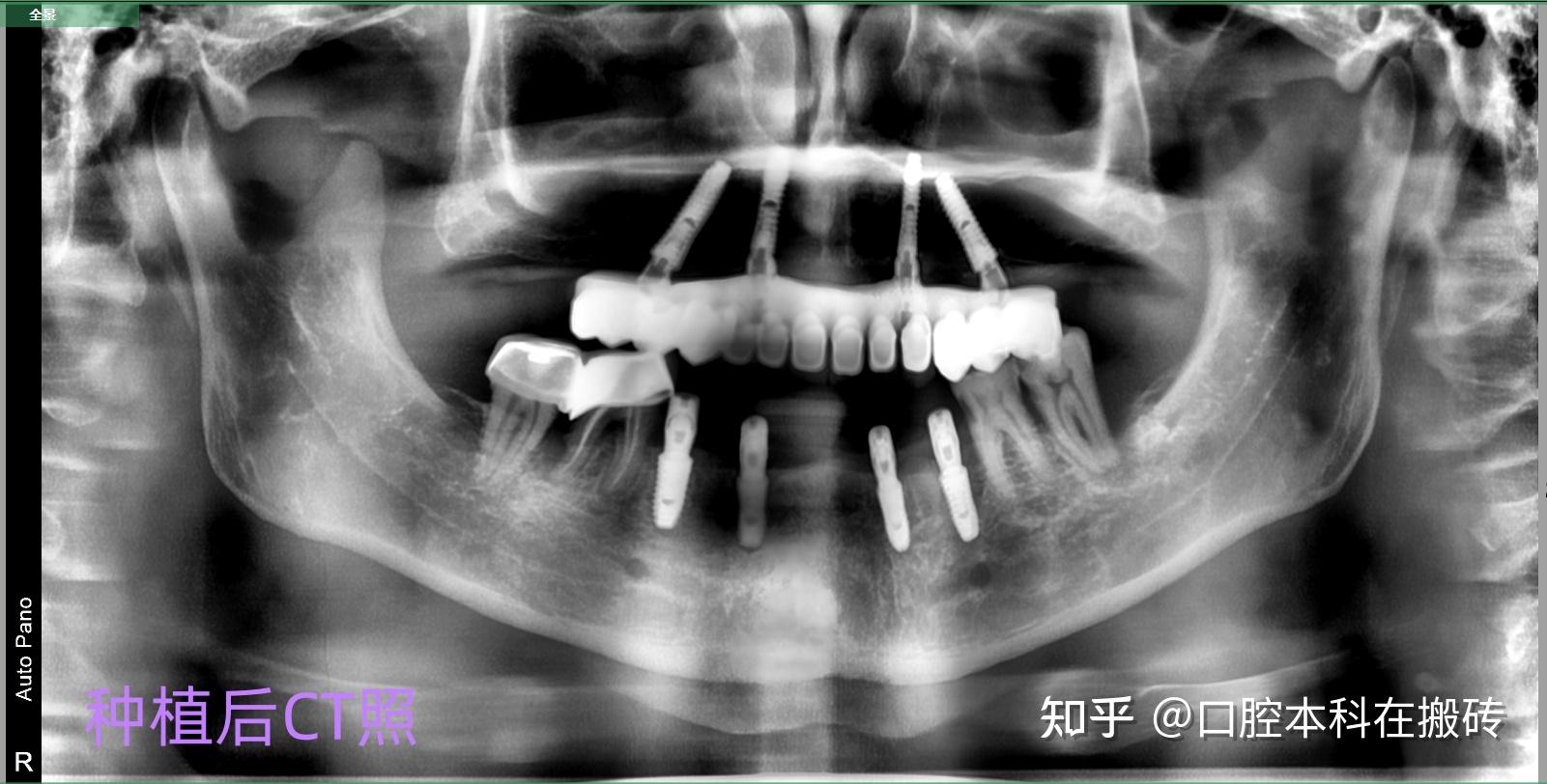 上半口种植修复,下半口即刻负重种植