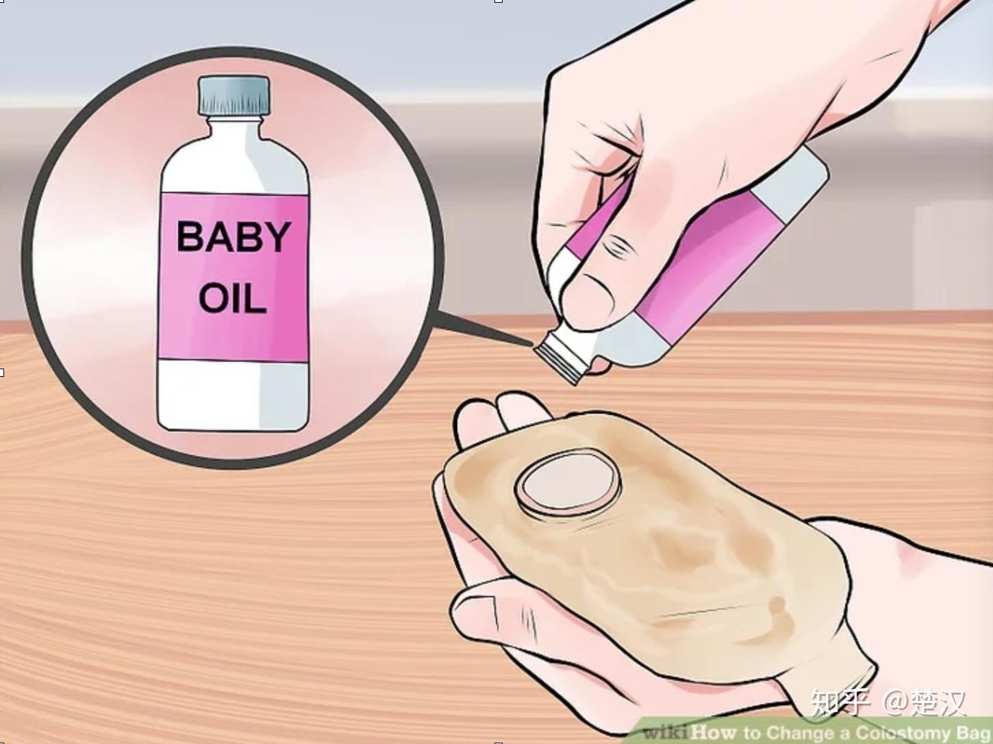 如何更换造口袋