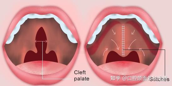 做过一次腭裂手术后还是发音不清楚,为什么,需要做二次手术吗?