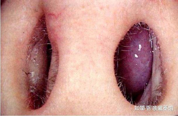 过敏性鼻炎怎么治爱莫迟