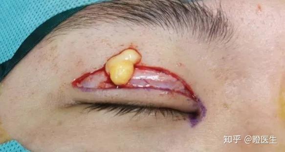 肿泡眼怎么消除去脂双眼皮手术还你大眼睛
