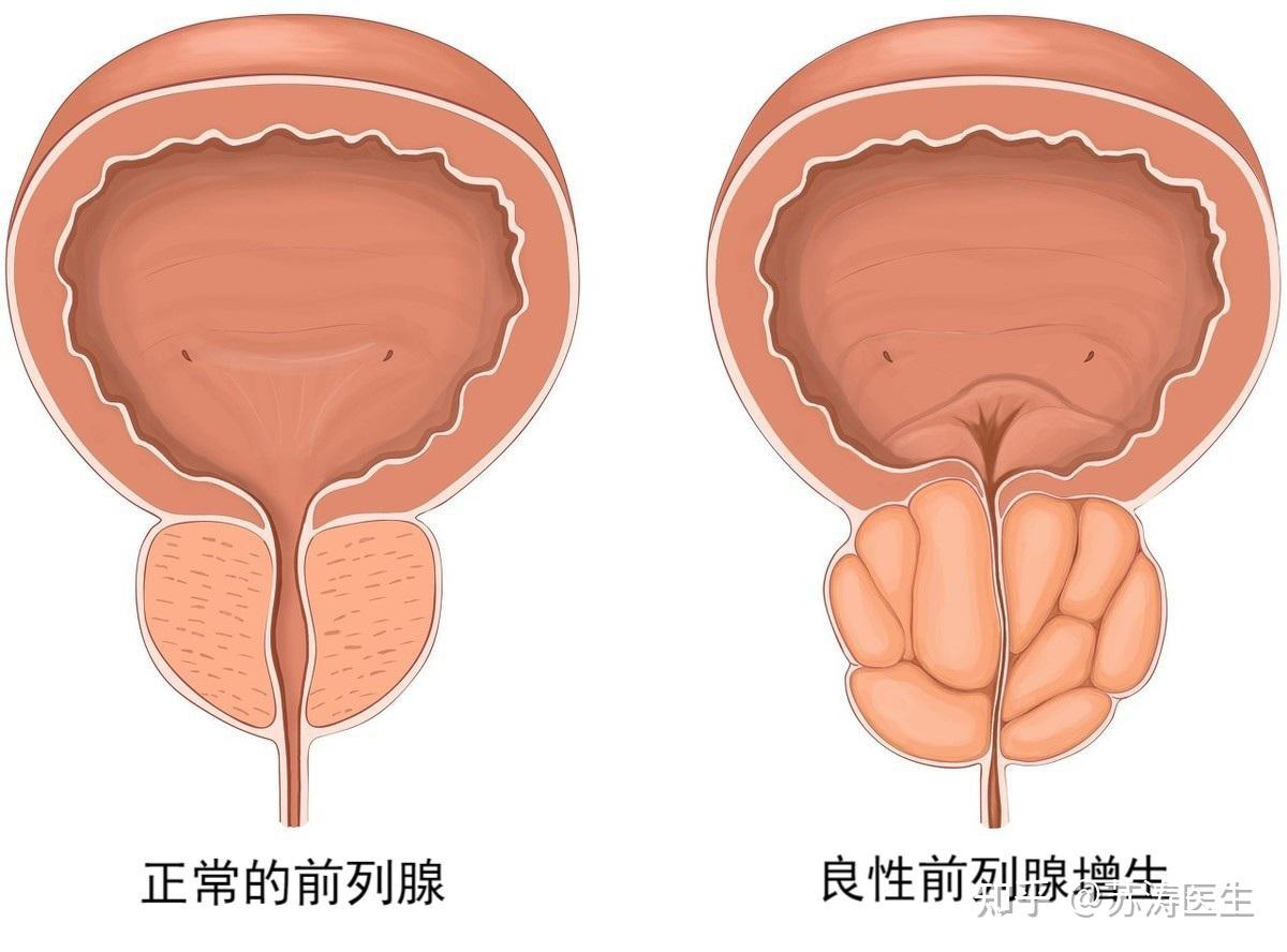 男性尿分叉型像图图片