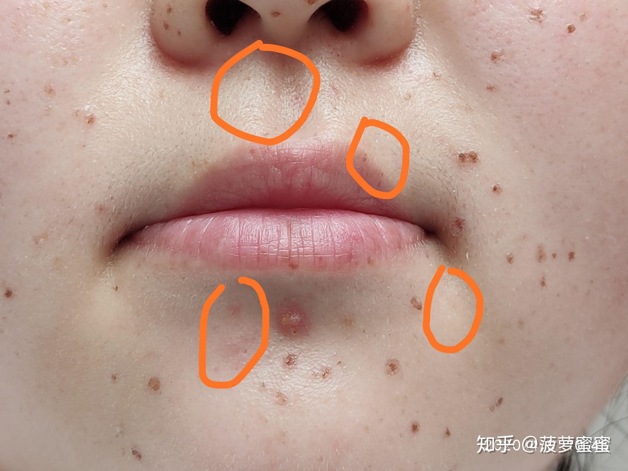 药水点斑图片可能会引起不适