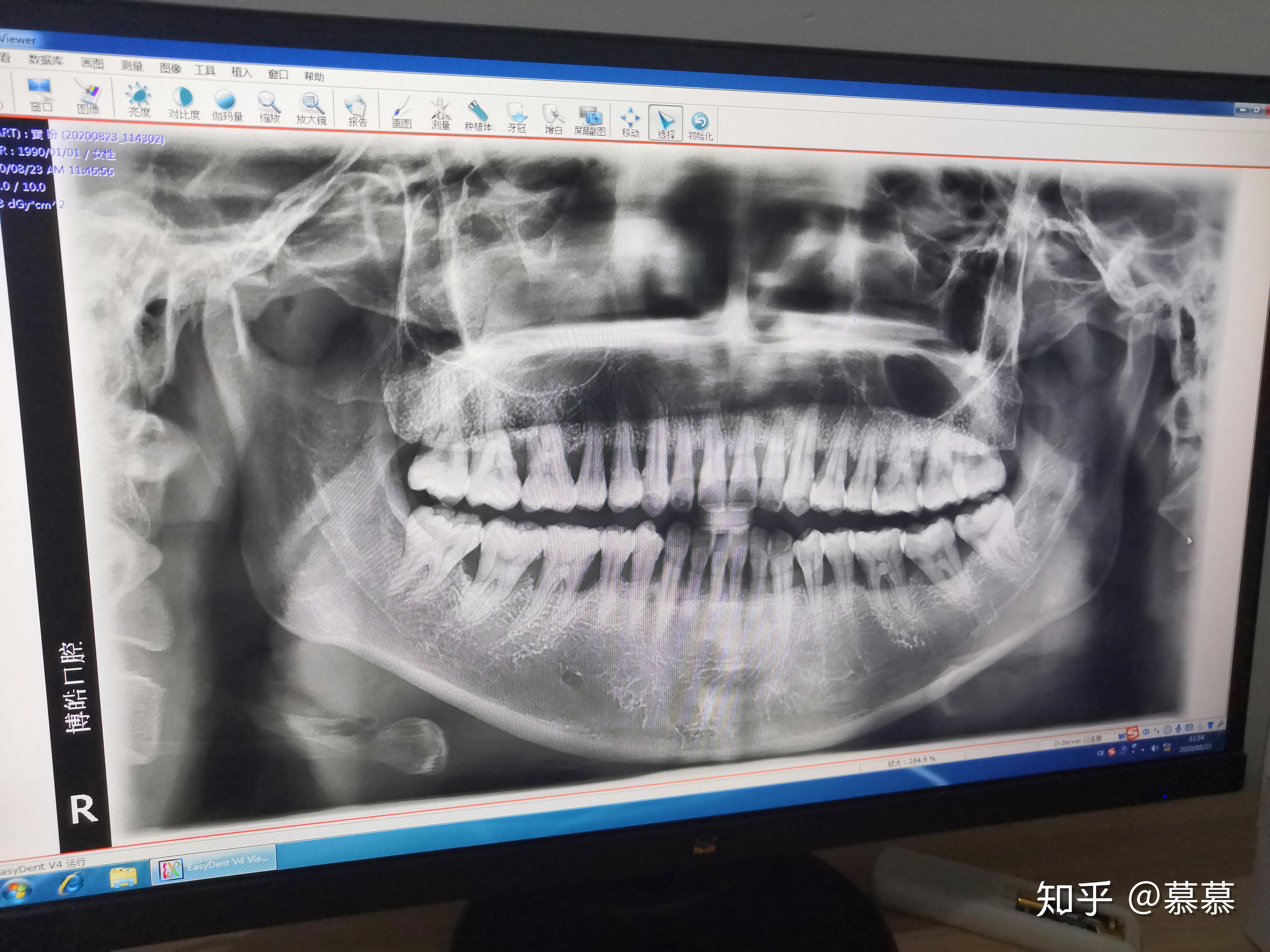 全口牙槽骨吸收