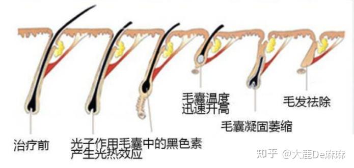 脱毛仪是智商税吗有没有效果 v2-461856ddc177cdd31396ed0f700e2a6e_r.jpg