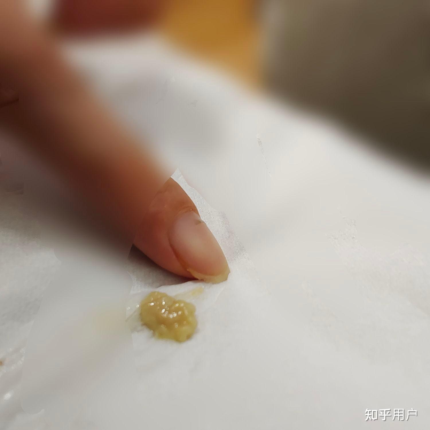 你見過最大的扁桃體結石有多大