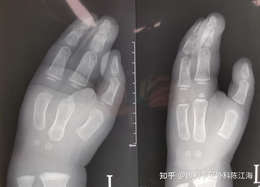 并指的最佳手术时间?并指合并别的手足畸形治疗效果(二) - 知乎