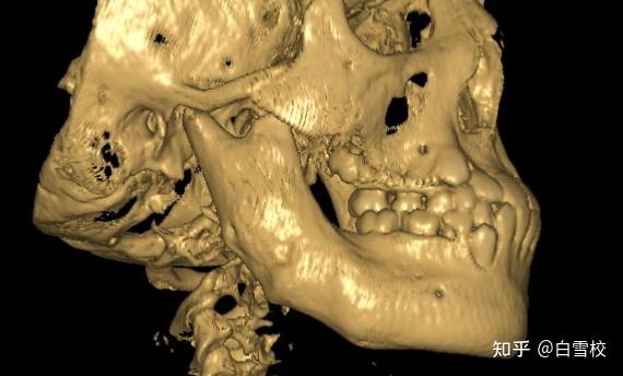 下颌骨弥漫硬化性骨髓炎——一种特殊类型骨髓炎的发现记