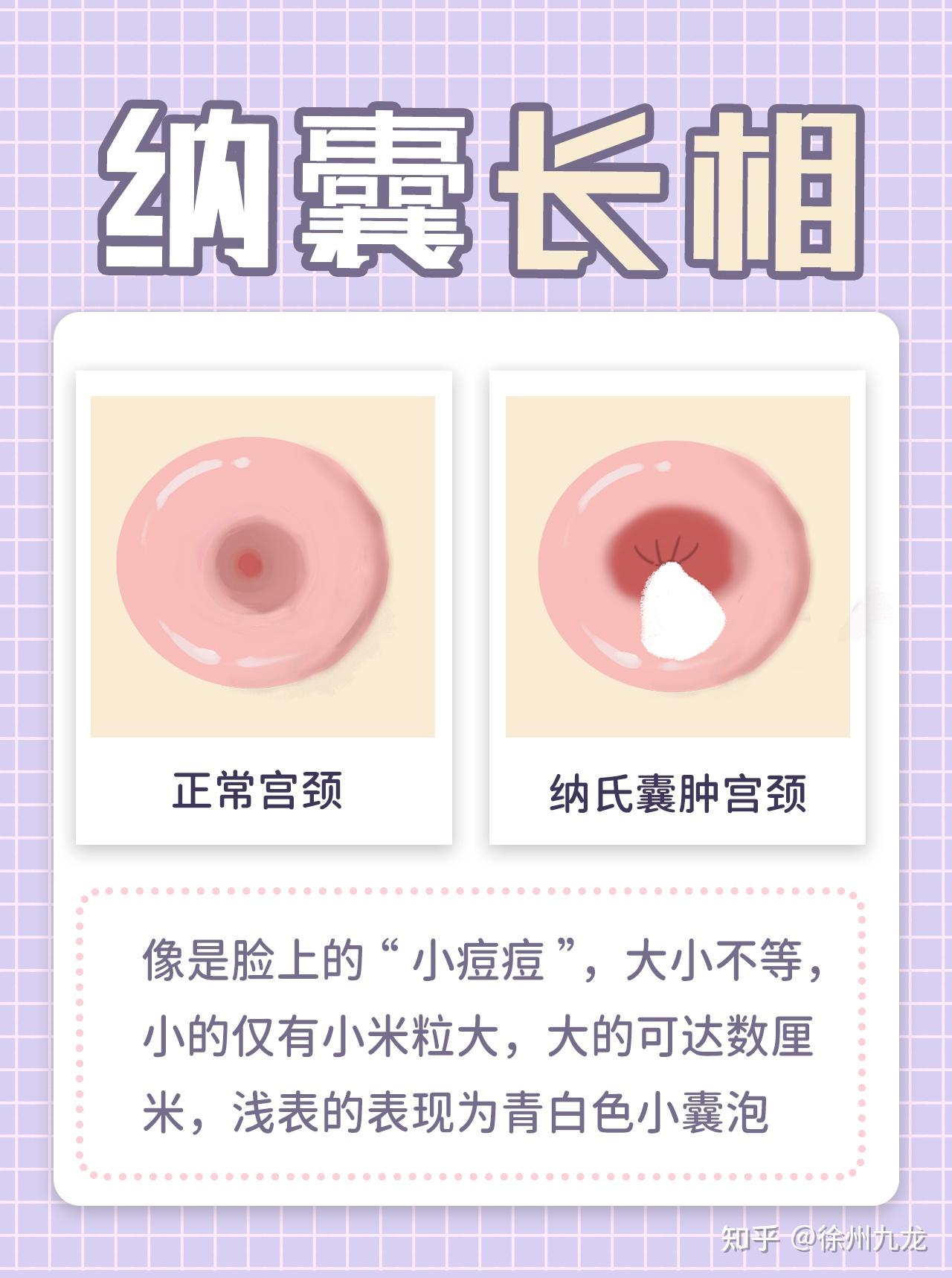 宫颈纳囊到底有没有事?