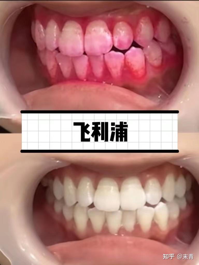 口腔护理必看2024电动牙刷5大品牌产品实测分析到底谁才是天花板