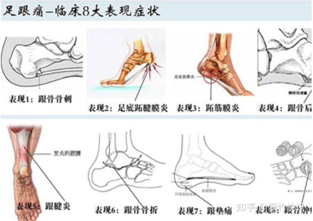 脚后跟疼痛图解图片