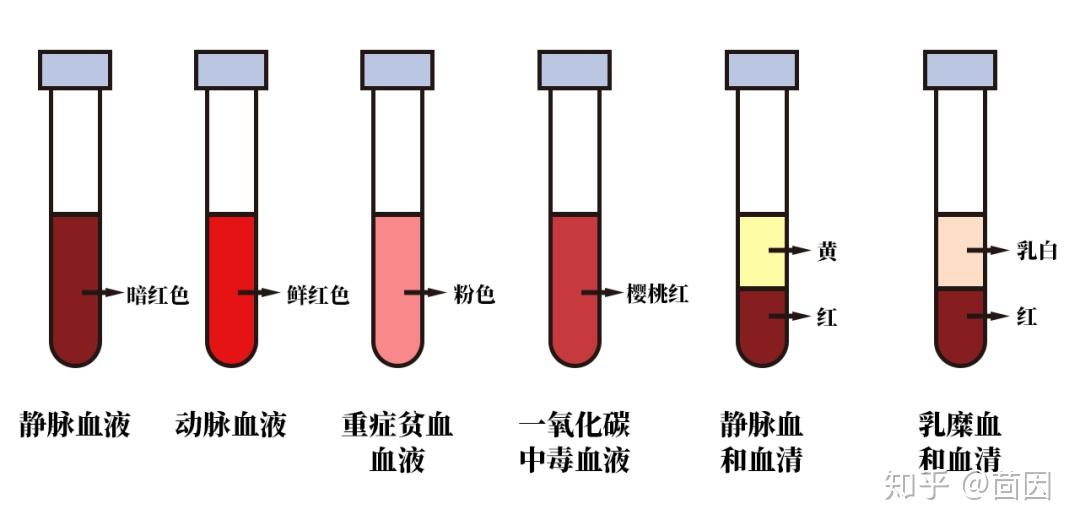 重症贫血的血液是粉红色,一氧化碳中毒是樱桃红色,正常血清呈现黄色