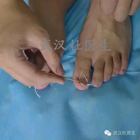 武汉杜医生--甲沟炎的治疗【图说塞棉花】