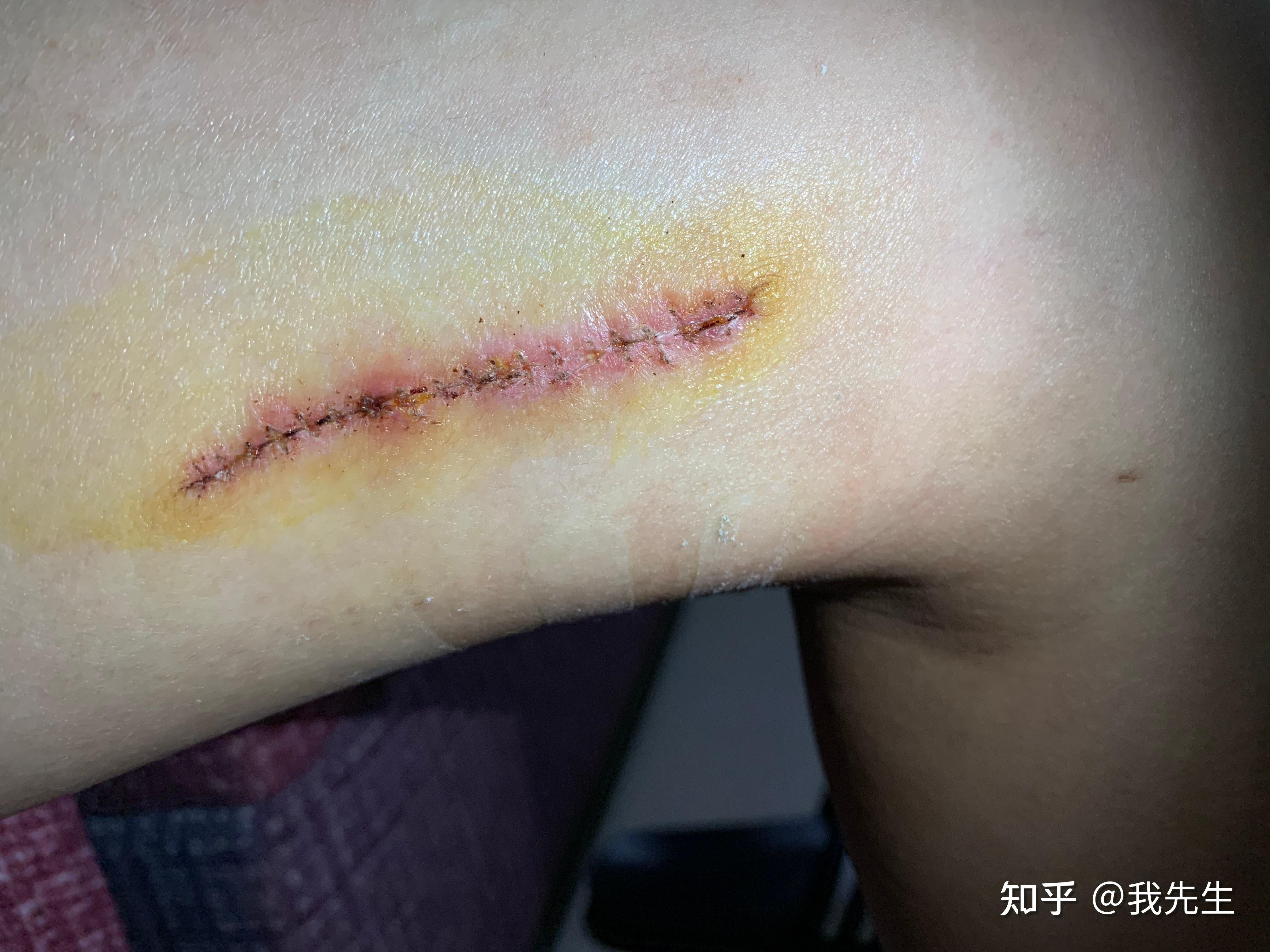 大腿内侧切痣是什么体验