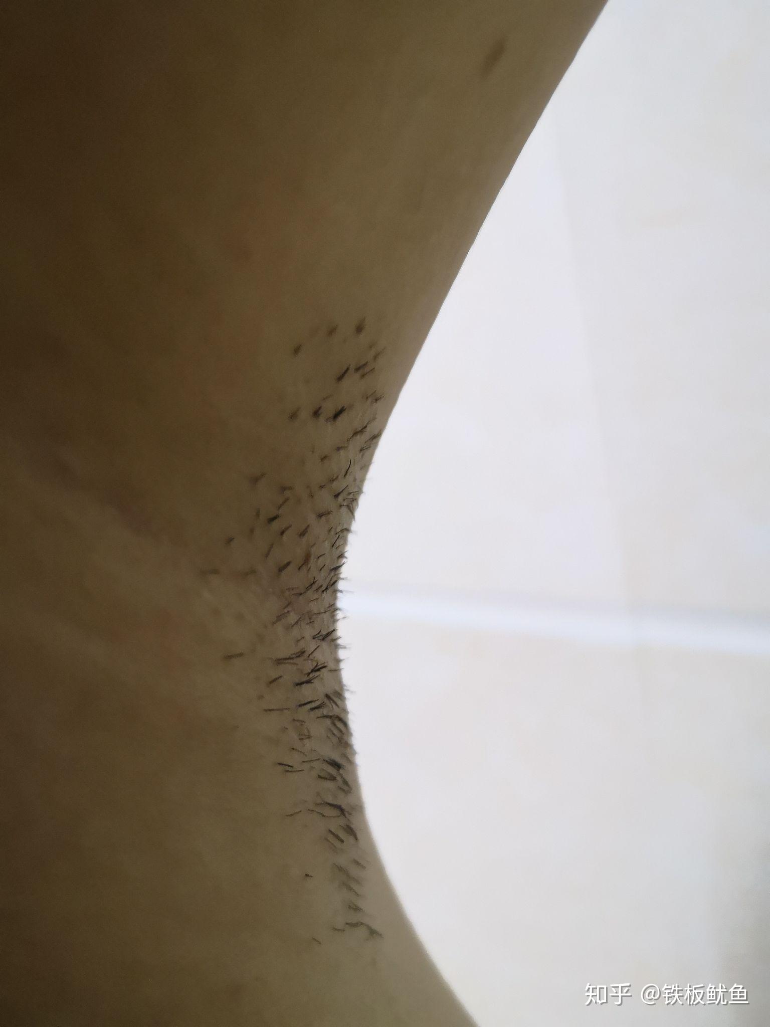 没有丝毫感觉 但有的毛还是拔的疼我觉得我的腿到了第二阶段了腋毛