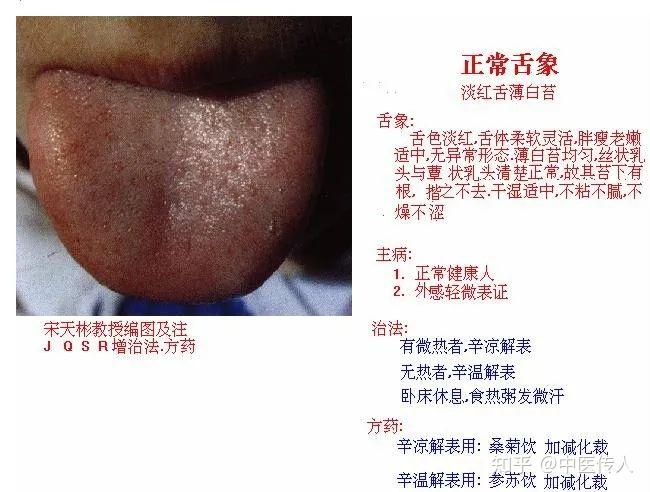 高清舌诊图解:各种临床证型舌象图谱大开眼界 - 知乎