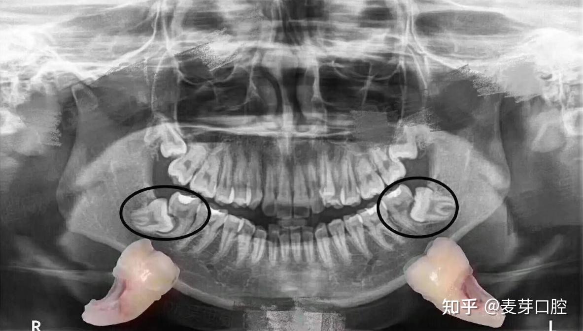 拍牙片辐射大不大?这3类人要看情况! - 知乎