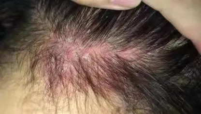 头发越来越少、头屑越来越多,你可能患上了头皮脂溢性皮炎! - 知乎