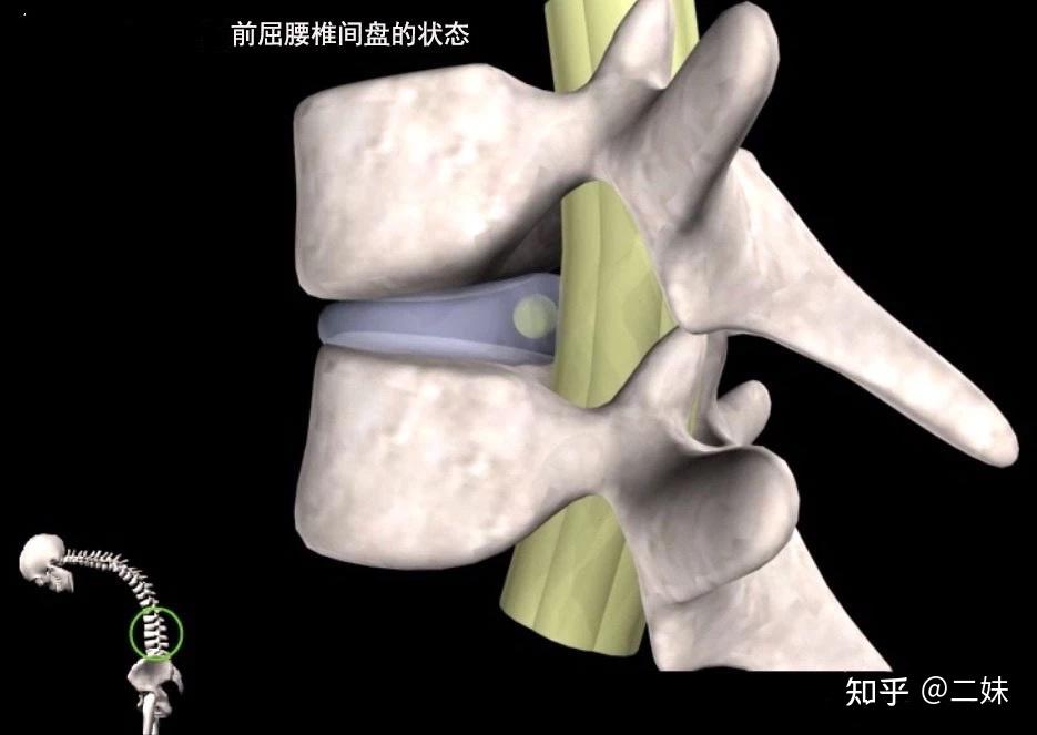 後移動;通過對解剖學的簡單學習,不難理解,人體正常狀態下,腰椎中的椎