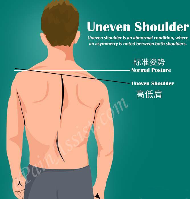 高低肩矫正中被忽略的重要一点 肩胛骨的位置 知乎