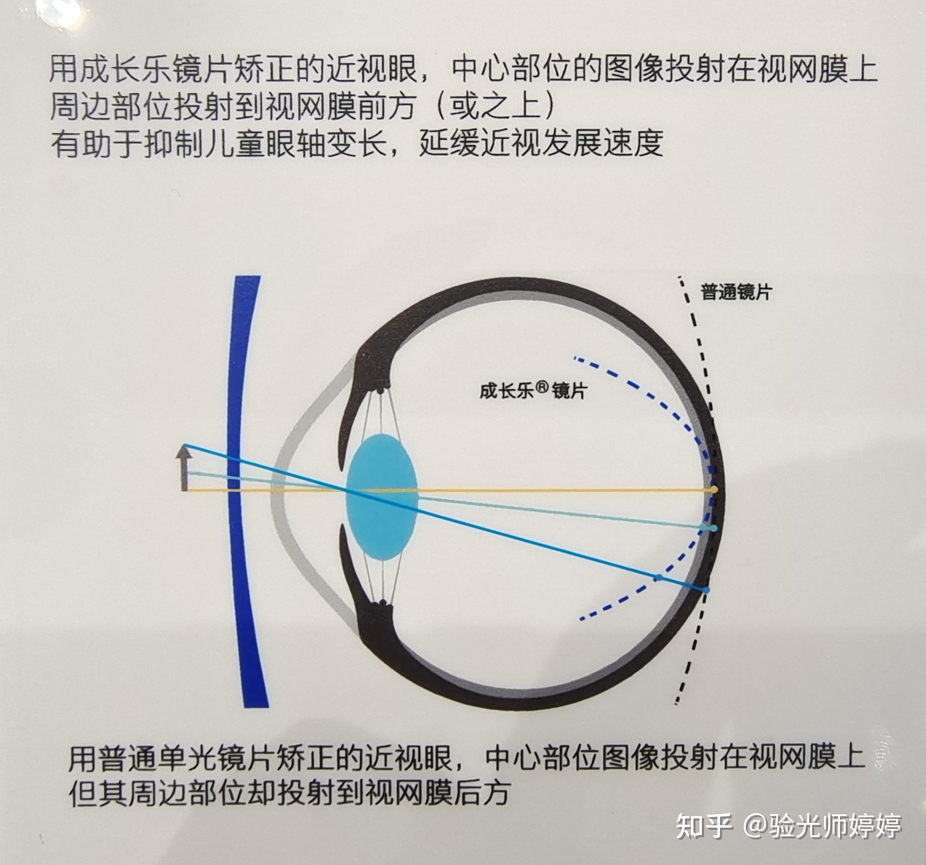 成长乐镜片原理图片