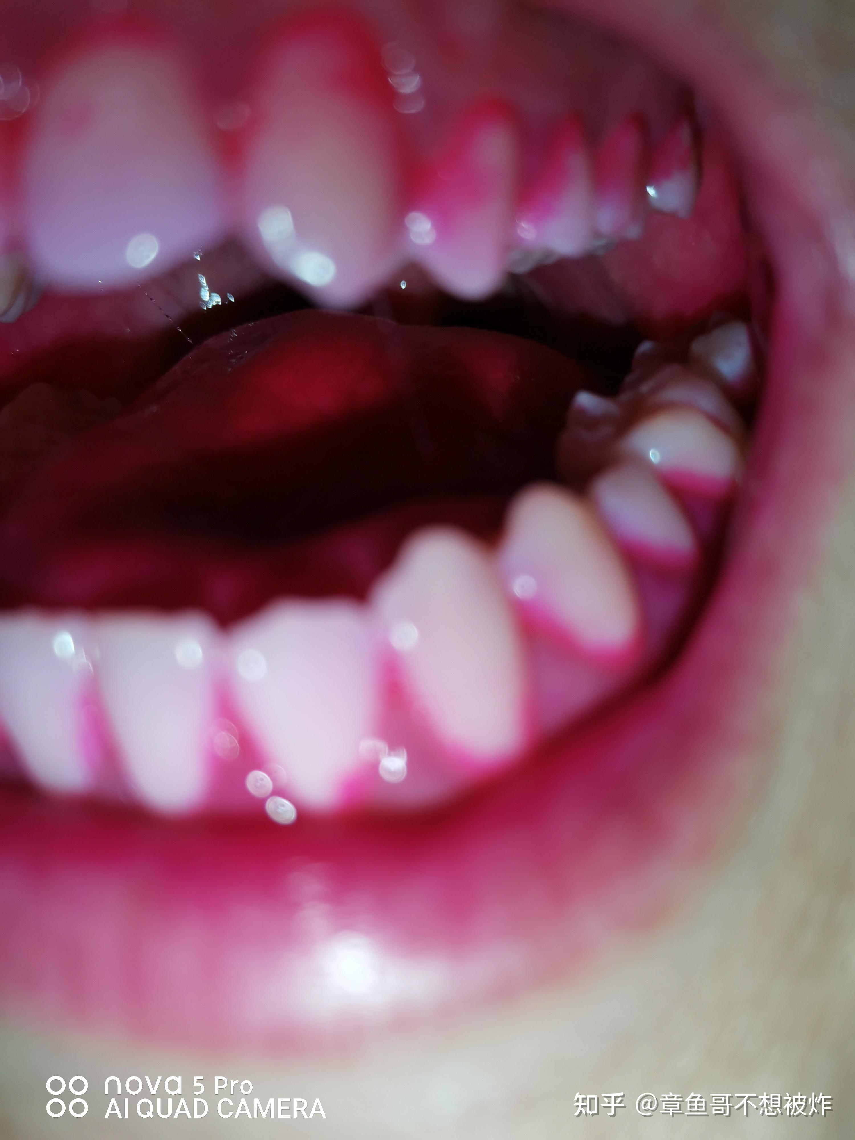 牙菌斑和色素的清洁_钟宏_住院医师_爱问健康