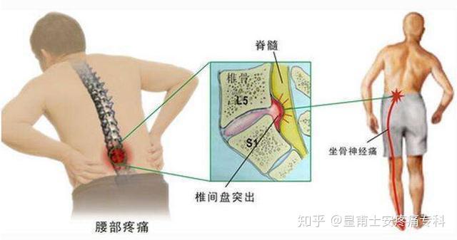 腰骶部疼痛指哪个部位图片
