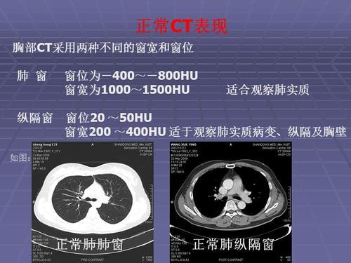 肺CT的种类那么多,该如何选择? - 知乎