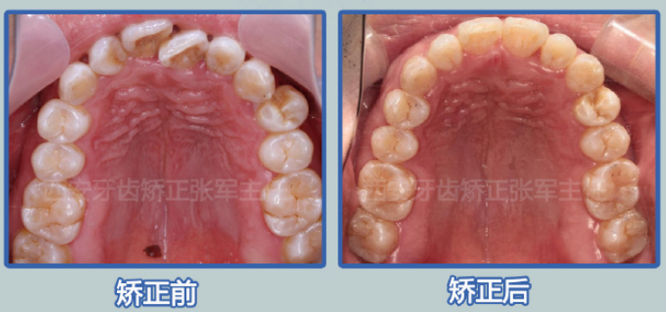 拔重叠牙危险图片