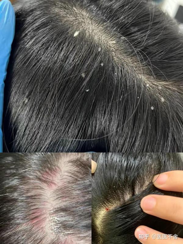 天天洗头,第二天依旧头皮屑特别多是什么原因造成的?该如何解决? - 知乎