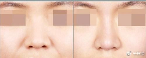 67嘴角纹——嘴角八字