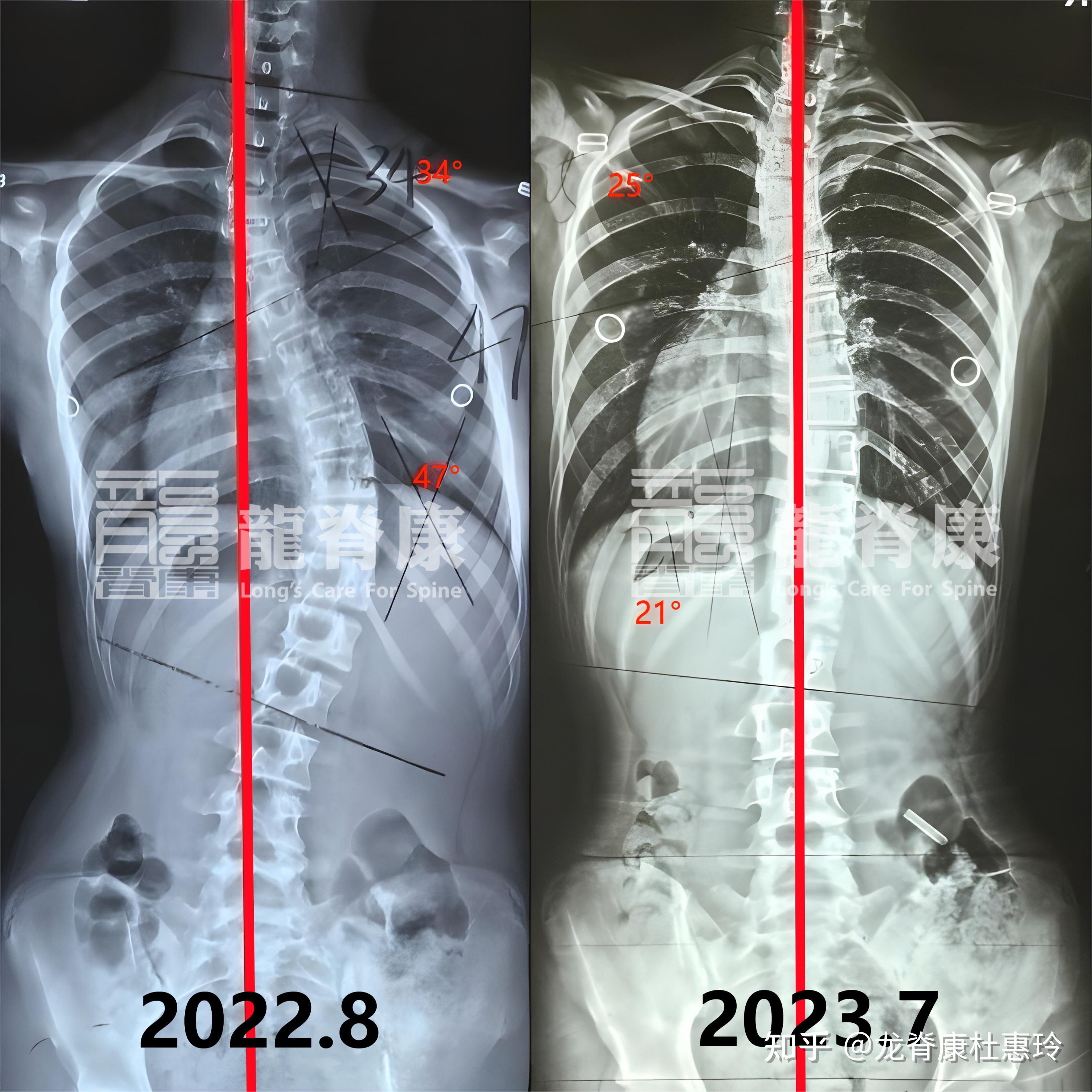 脊柱侧弯10度外观图片图片