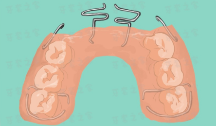 为什么有的人矫正牙齿要垫颌垫有的人又不用