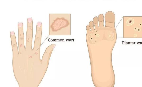 注意 疣体成群 全是因为这几点 知乎