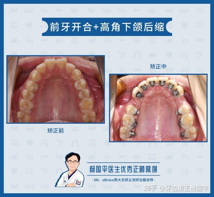 上海舌侧矫正前牙开合高角下颌后缩矫正中案例分享