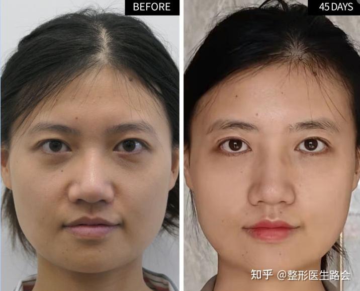 美容整成毁容?惠州一女子“泪沟填充”失败,真实感受只有自己知道 - 知乎