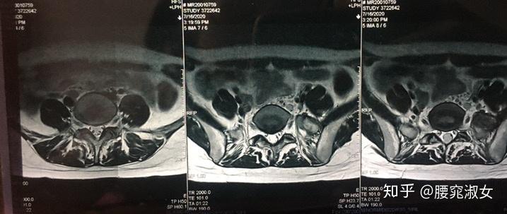 啥是微创手术 v2-47dd429c6866843e64411e226dfe8dce_r.jpg