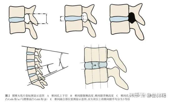 椎管测量示意图图片