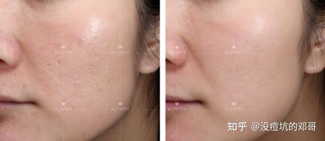 如何用医美手段收缩可以插秧的毛孔最全指南篇