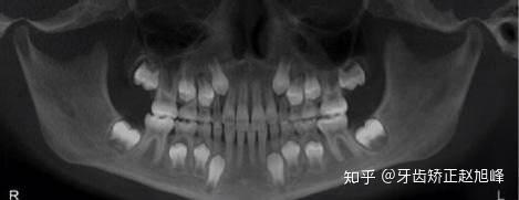 牙齿是从哪里长来的 知乎