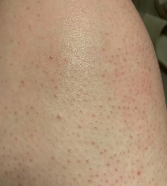 鸡皮肤红疙瘩怎么去除(鸡皮肤红疙瘩怎么去除图片) 鸡皮肤红疙瘩怎么去除(鸡皮肤红疙瘩怎么去除图片)